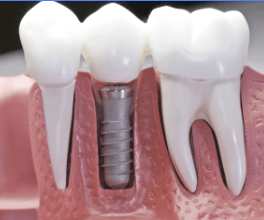 Implantes