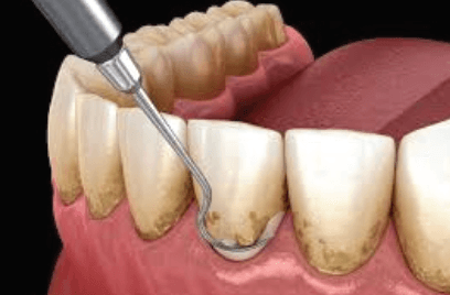 Periodoncia